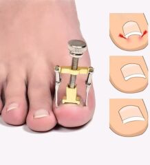 Batık Tırnak Çıkarma Aparatı