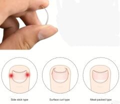 Ayak Tırnak Batmasını Önleyen Metal Aparat – Sağlıklı ve Konforlu Çözüm